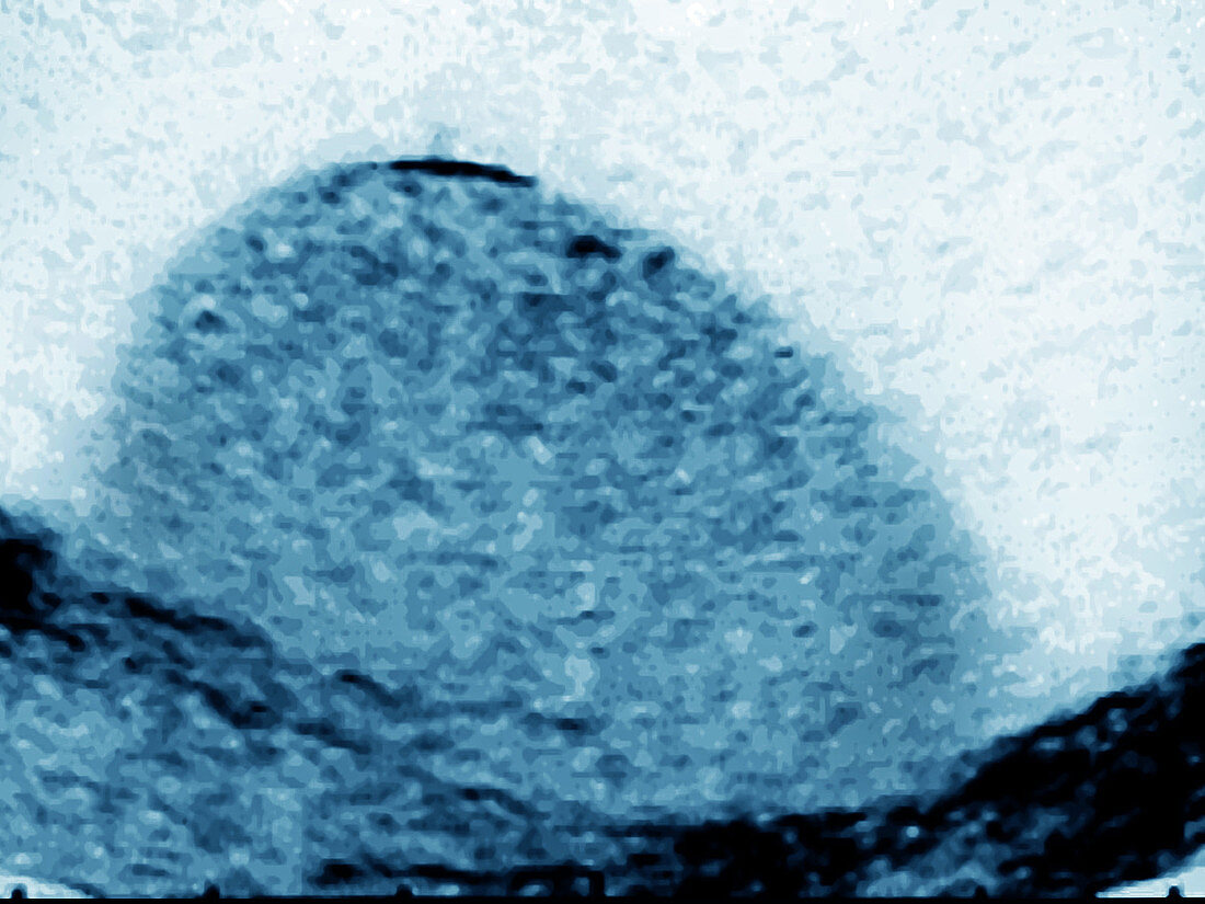 Ultrasound of Hydrocele around Testicle
