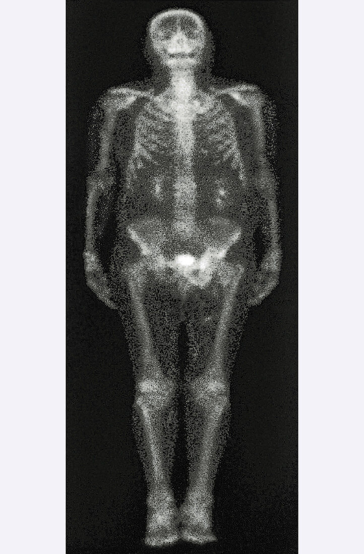 Obese Person,Gamma Scan