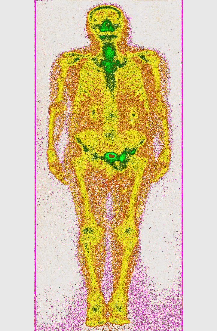 Obese Person,Gamma Scan