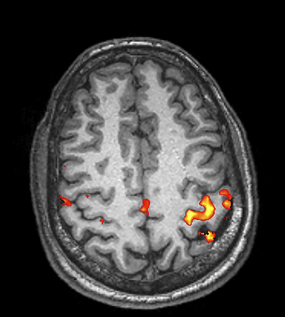 Brain,Functional MRI (fMRI)