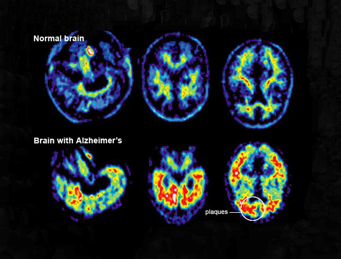 Normal and Alzheimer Brains,PET Scans