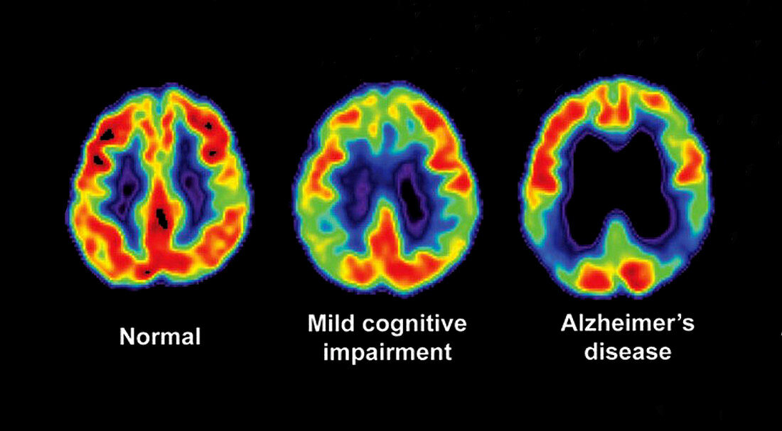 Normal,Impaired and Alzheimer Brains
