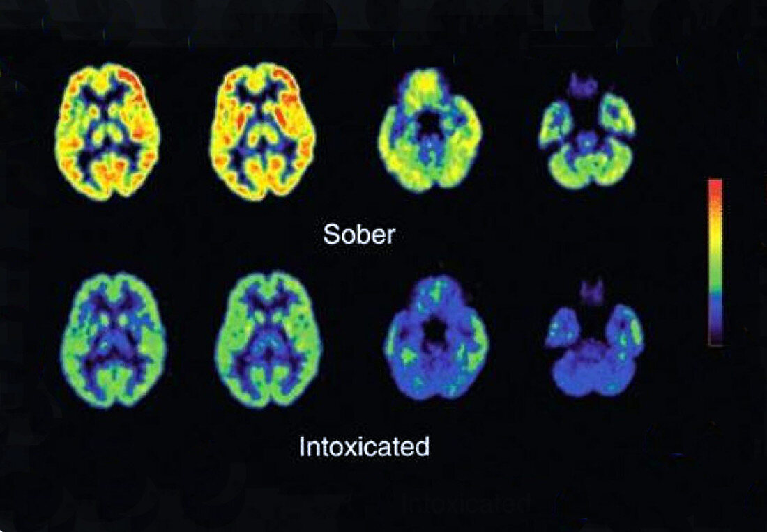 Sober and Intoxicated Brains,PET Scans
