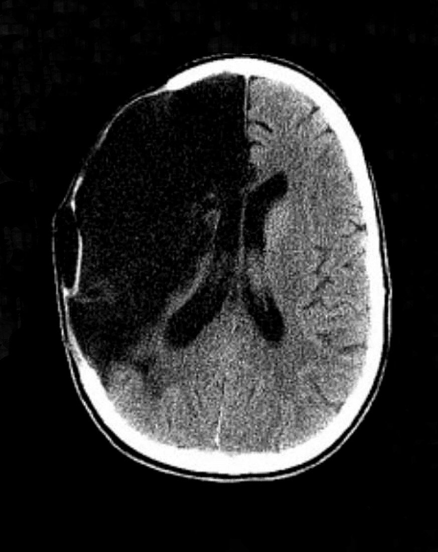 Brain Stroke,CT Scan