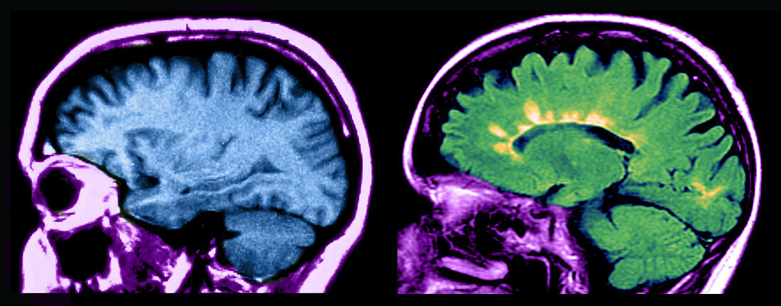 MRI of Normal Brain and MS Lesions