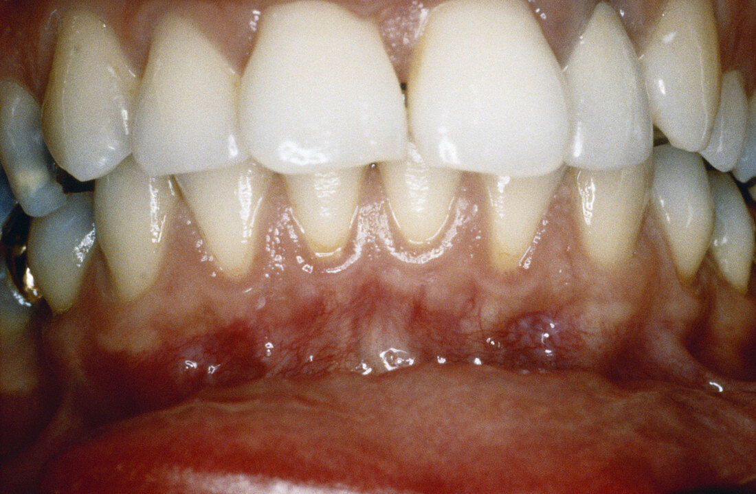 Attached Gingiva