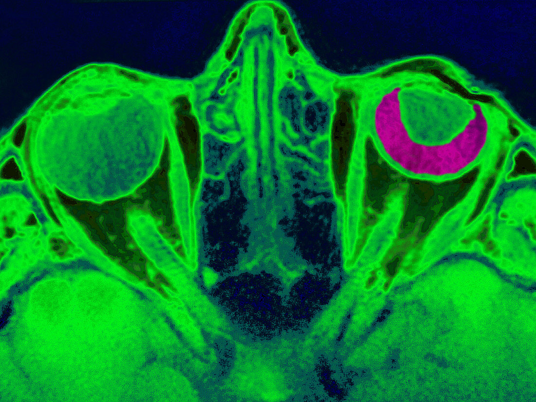 Retinal Detachment,MRI