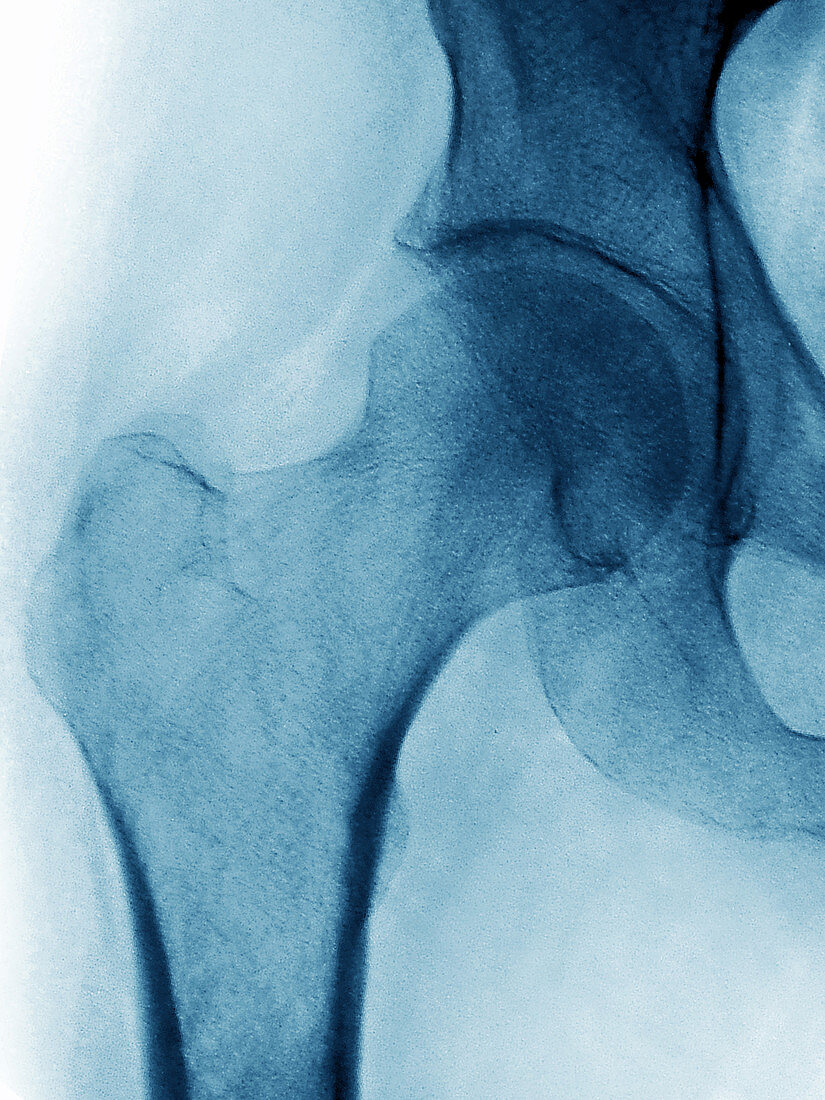 Normal Hip,X-ray