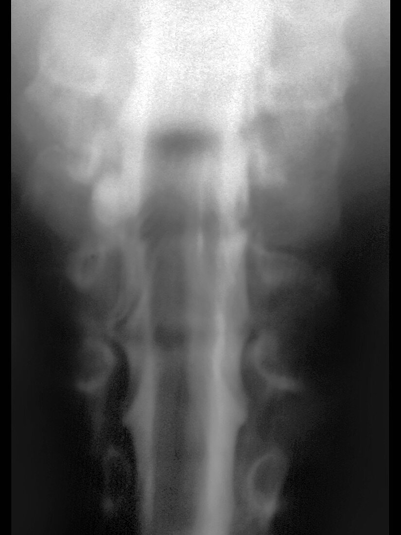 Meningocele,X-ray