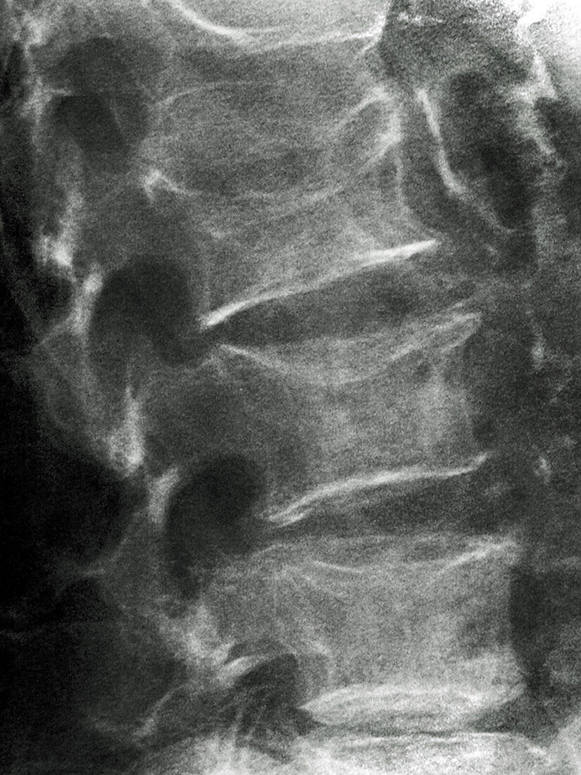 Osteoporosis,X-ray
