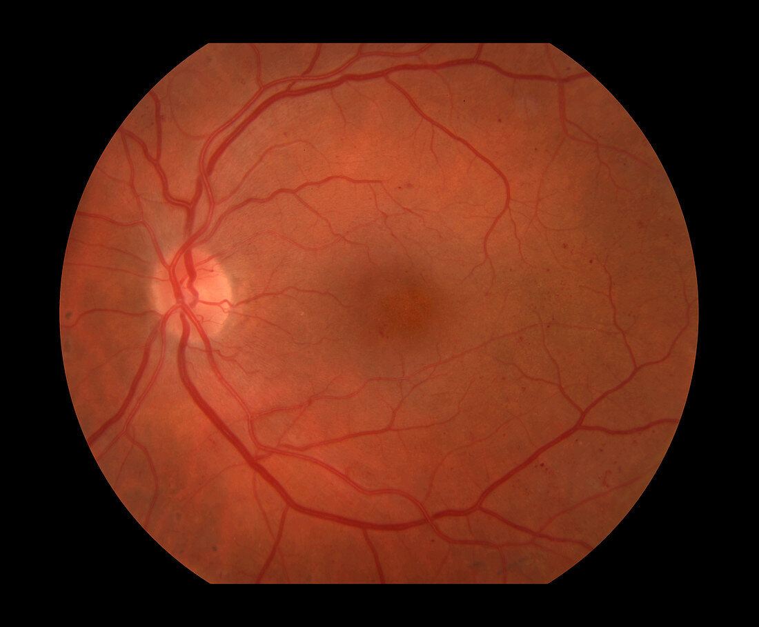 Diabetic Retinopathy,2 of 5