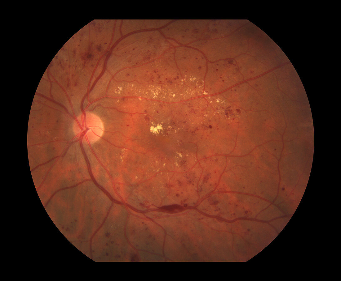 Diabetic Retinopathy,4 of 5