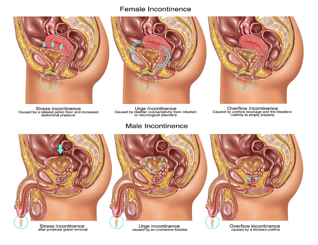 Types of Incontinence,Illustration
