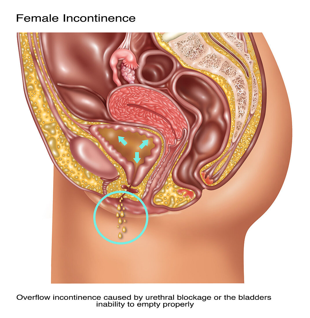 Overflow Incontinence in Female Anatomy