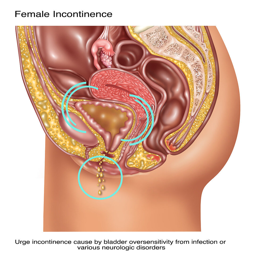 Urge Incontinence in Female Anatomy