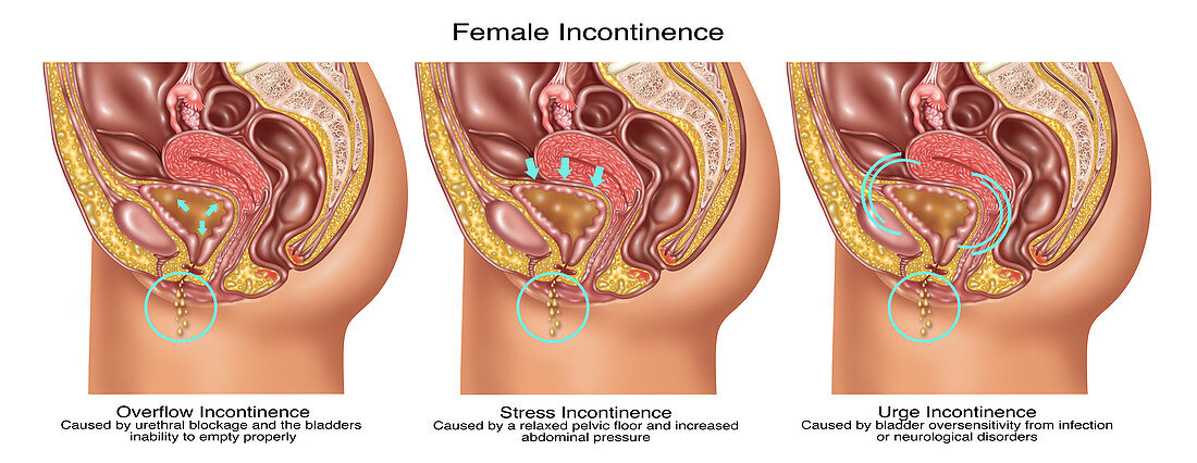 Types of Incontinence in Female Anatomy