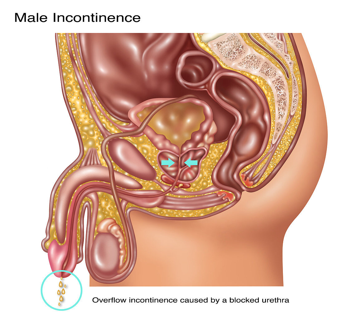 Overflow Incontinence in Male Anatomy