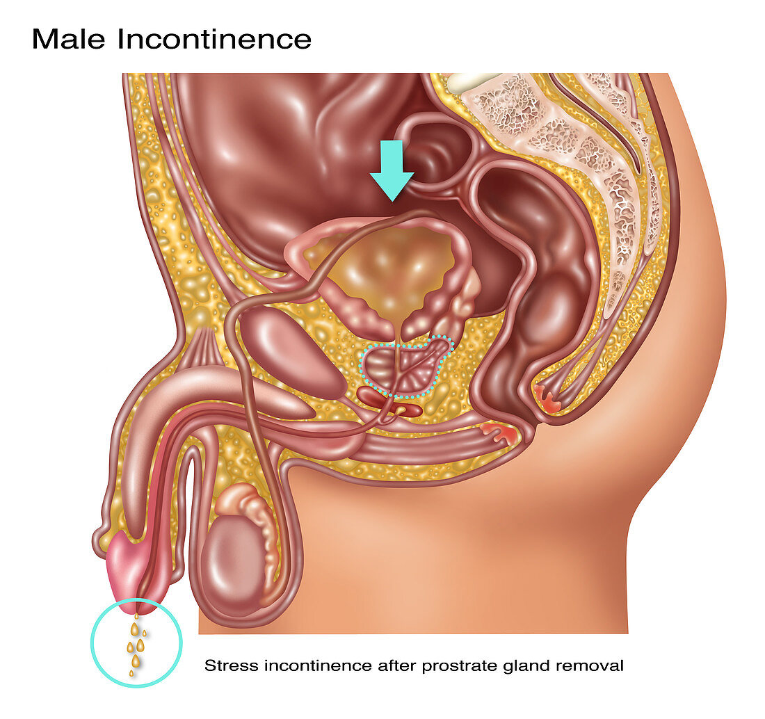 Stress Incontinence in Male Anatomy