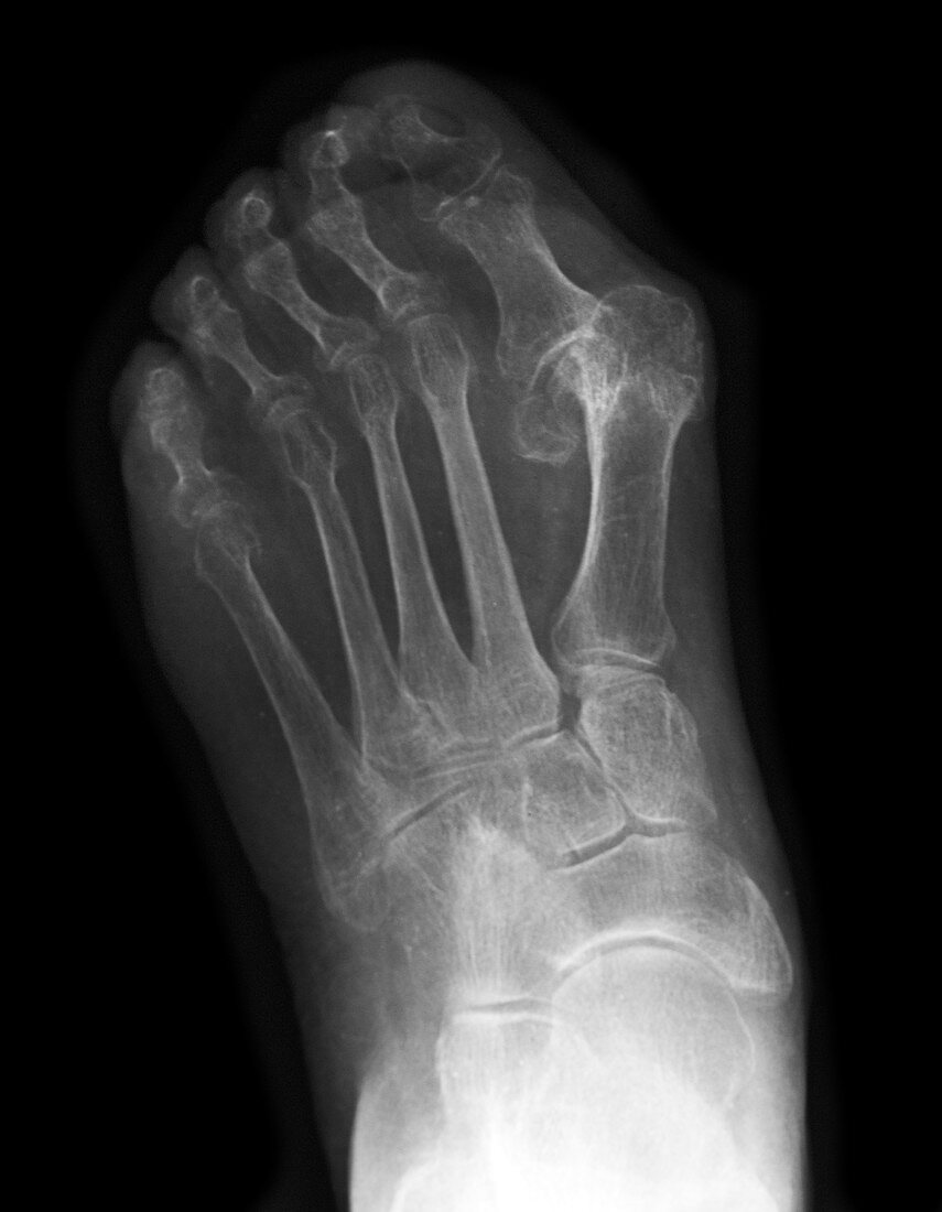 Foot X-ray Showing Bunions
