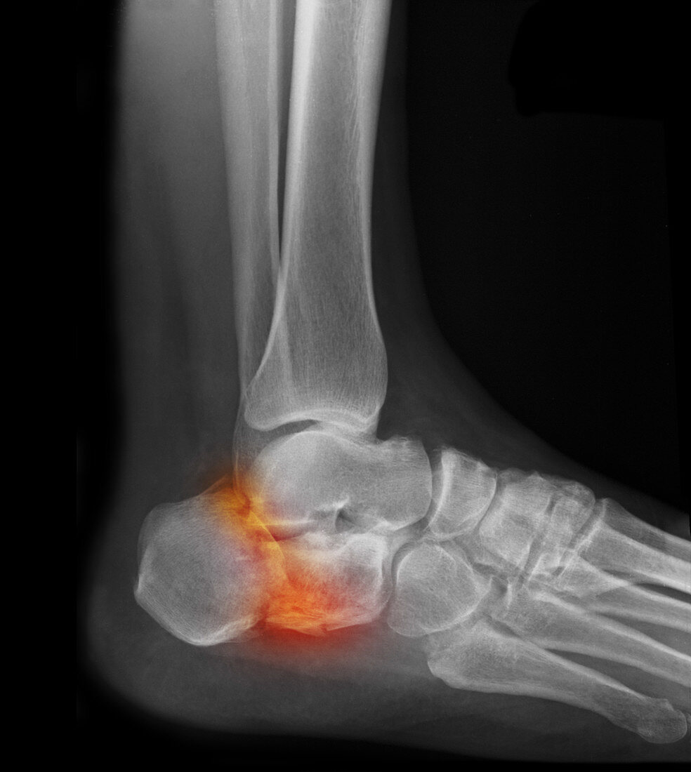 Fractured Heel,X-ray