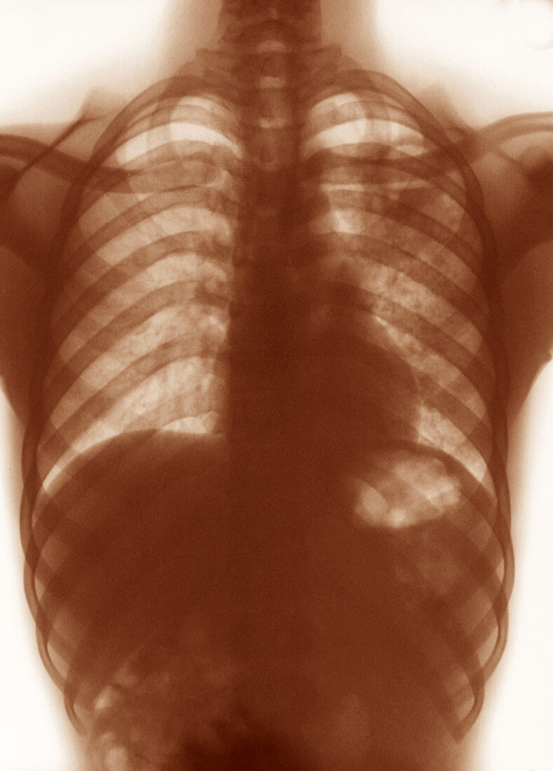 X-ray Showing Tuberculosis