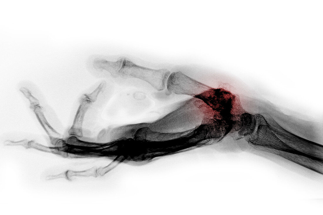 Arthritis in Hand,X-ray