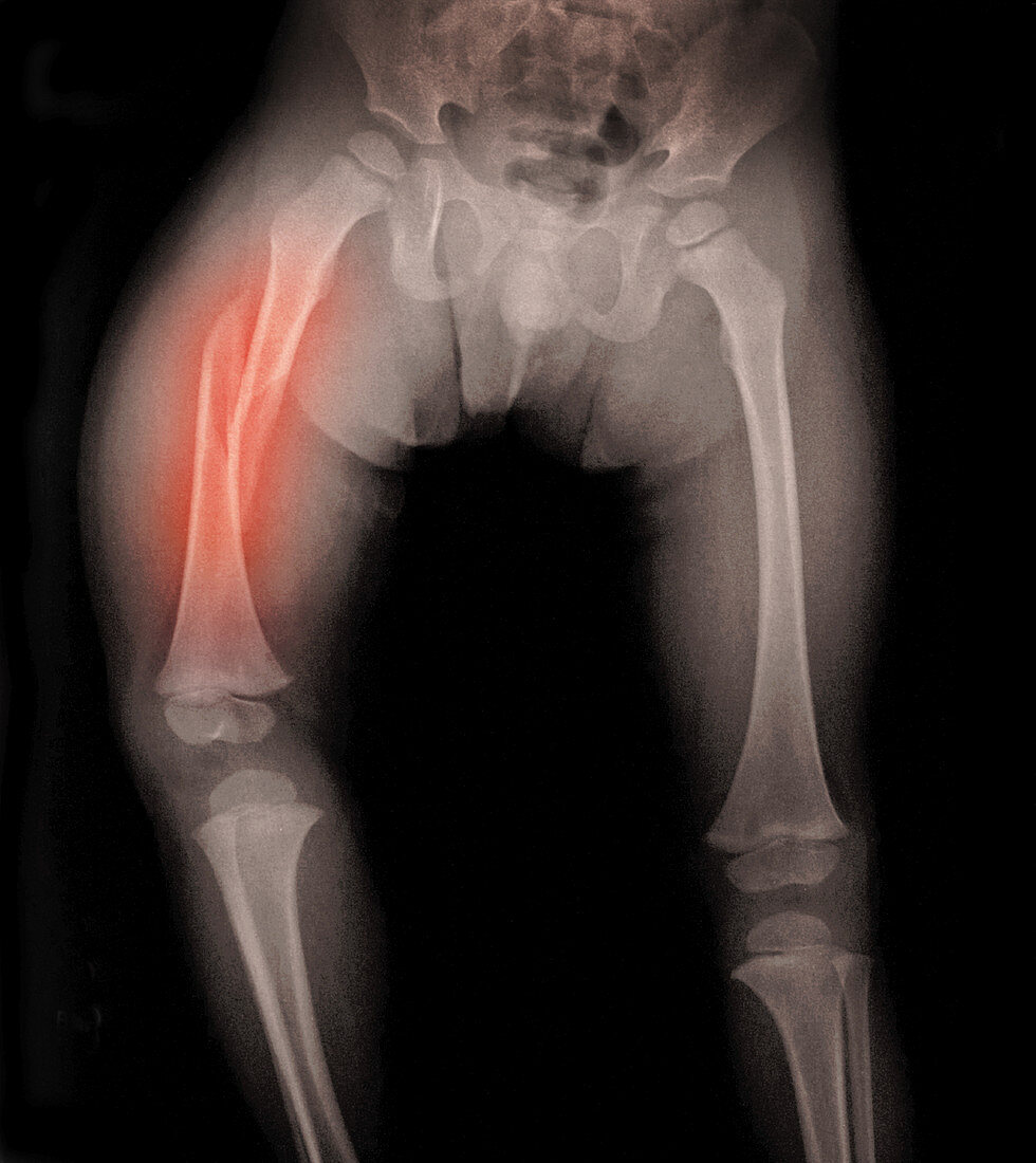 Femur Fracture,X-ray