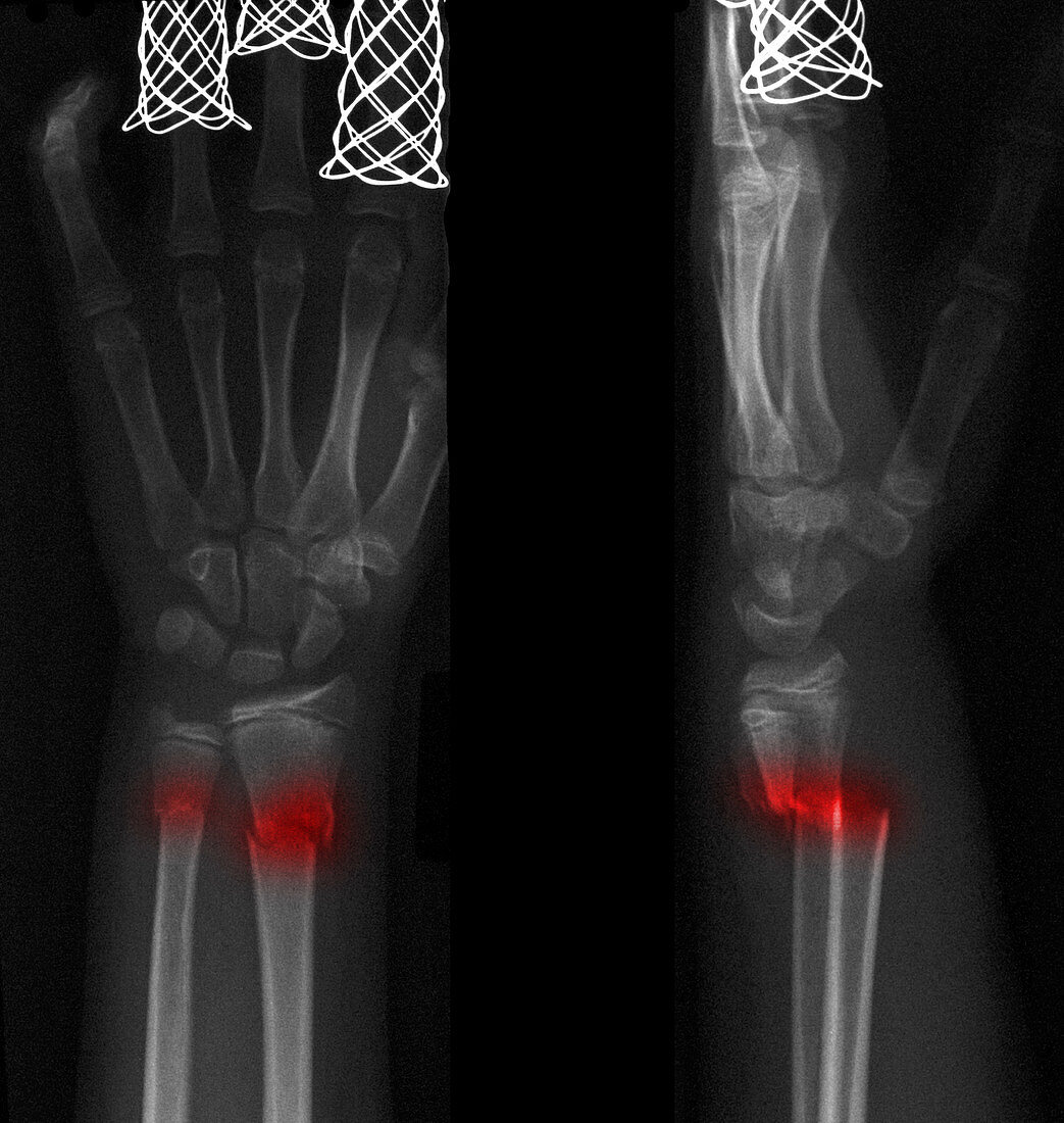 Forearm Fracture and Realignment