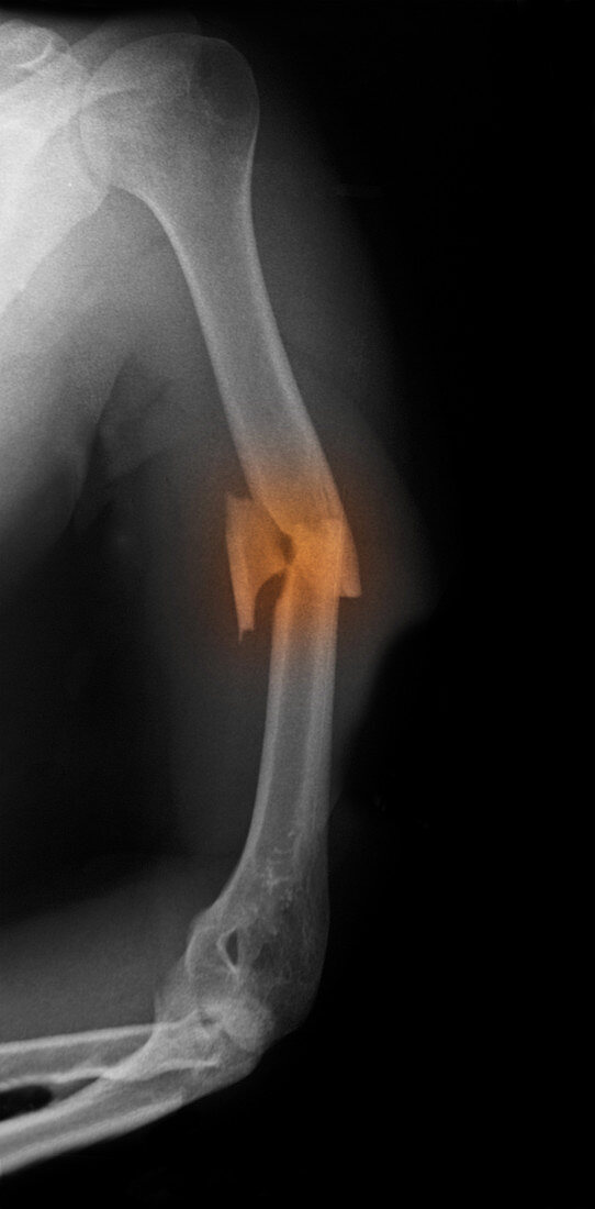 Humerus Fracture,X-ray