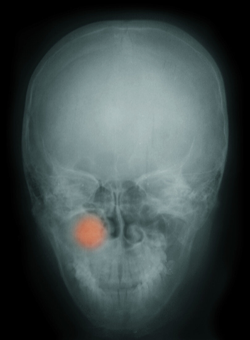 Maxillary Sinus Tumour,X-ray