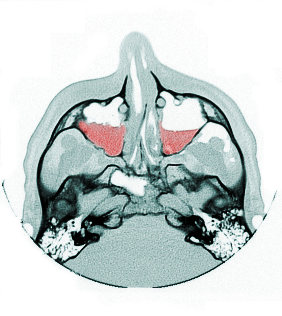 Maxillary Sinus Fractures,CT