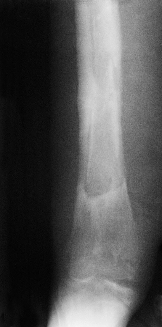 Osteomyelitis of Tibia,X-ray
