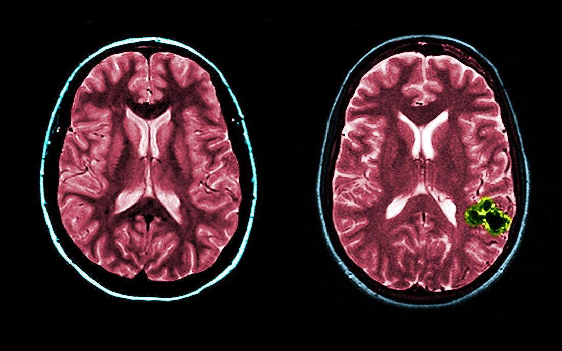 MRI of Normal and AVM Brains
