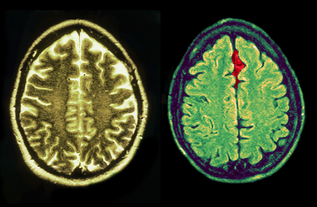 MRI of Normal and Injured Brains