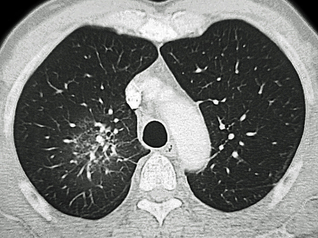 Pulmonary Arteritis