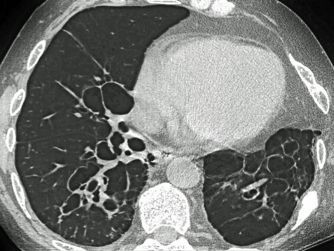 Cystic Fibrosis,CT Scan