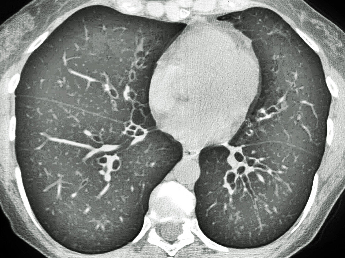 Cystic Fibrosis,CT Scan