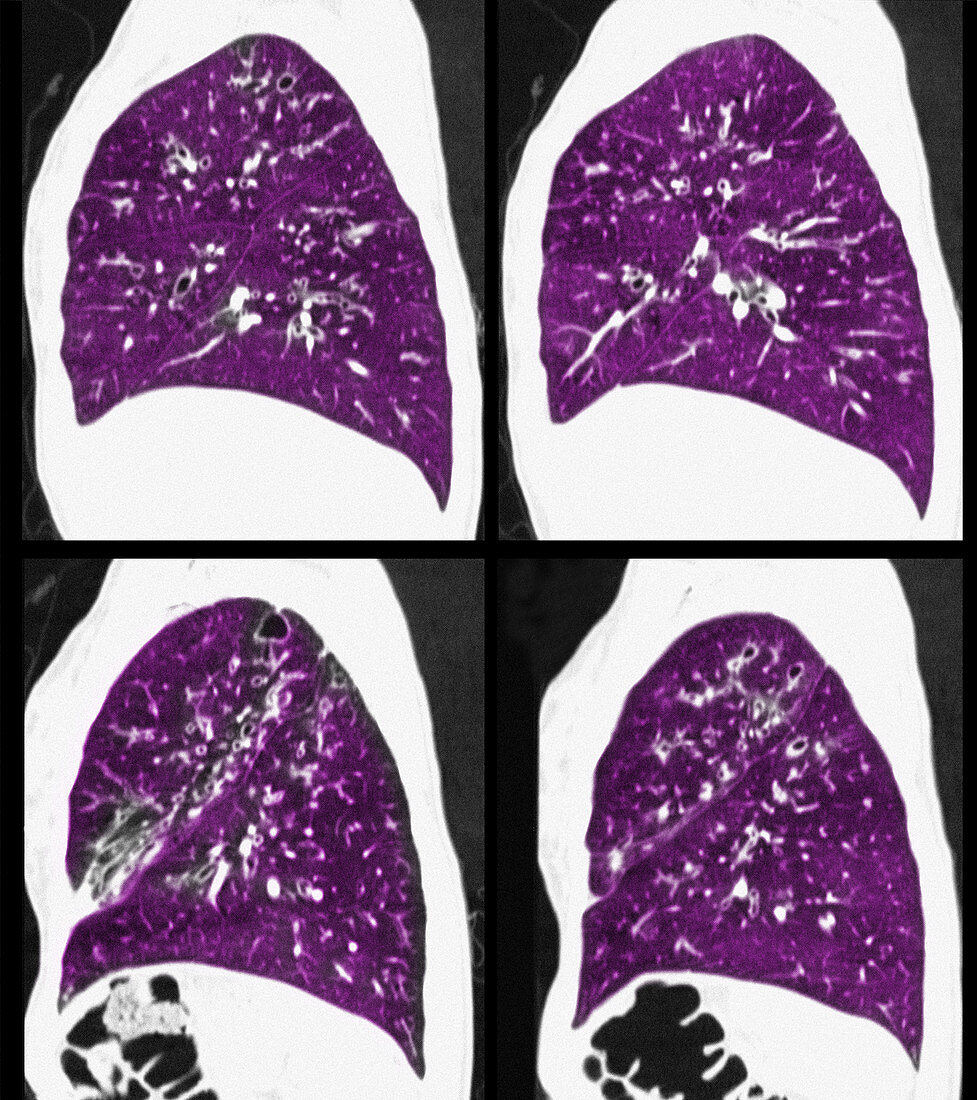 Cystic Fibrosis of the Lungs,CT Scan