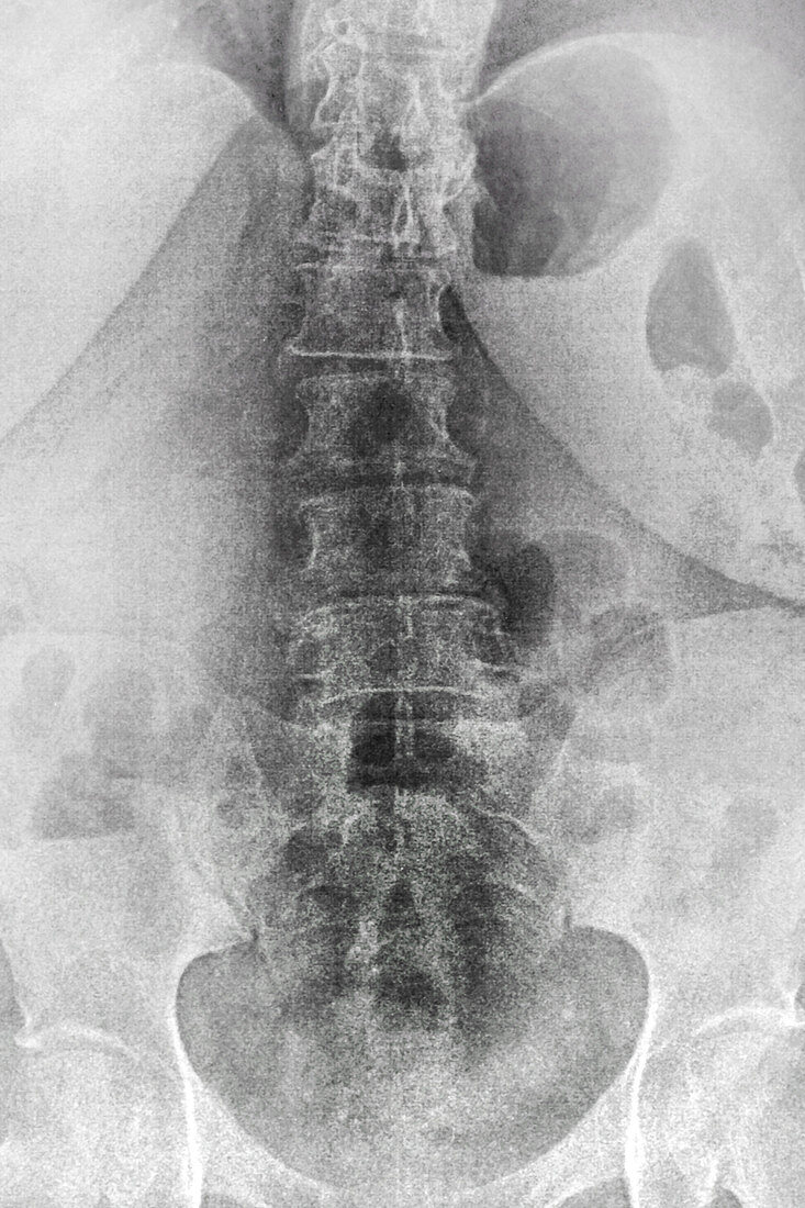 Degenerative disc disease,X-ray