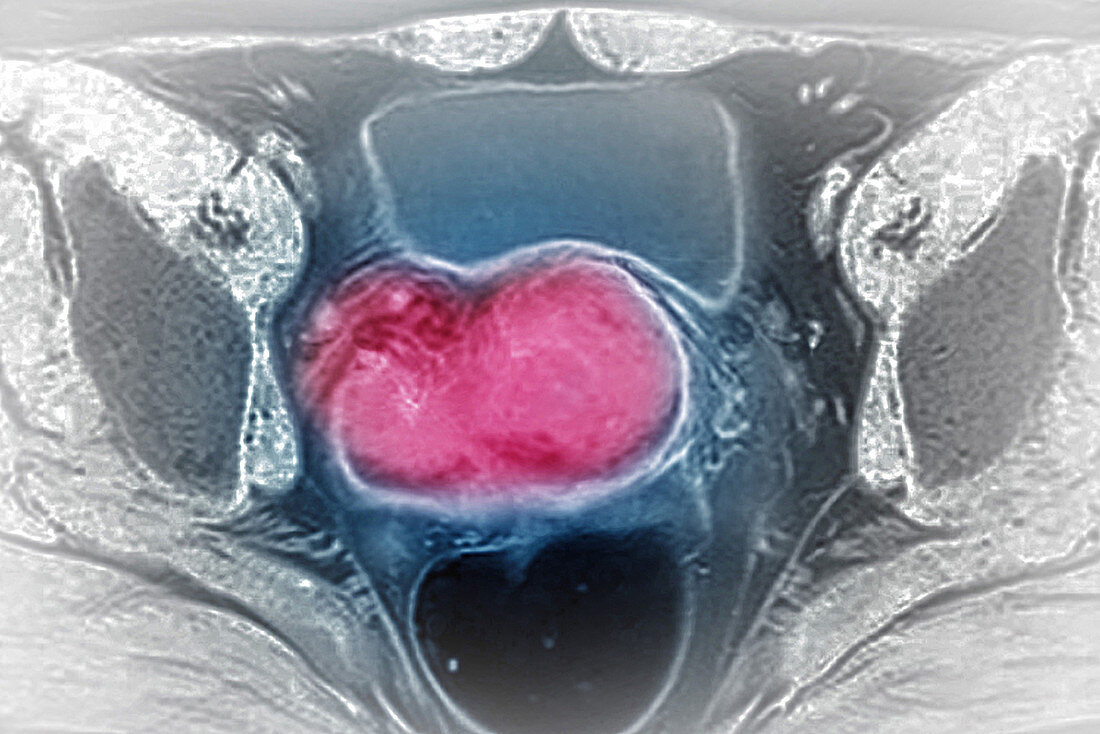 Cervical Cancer,MRI
