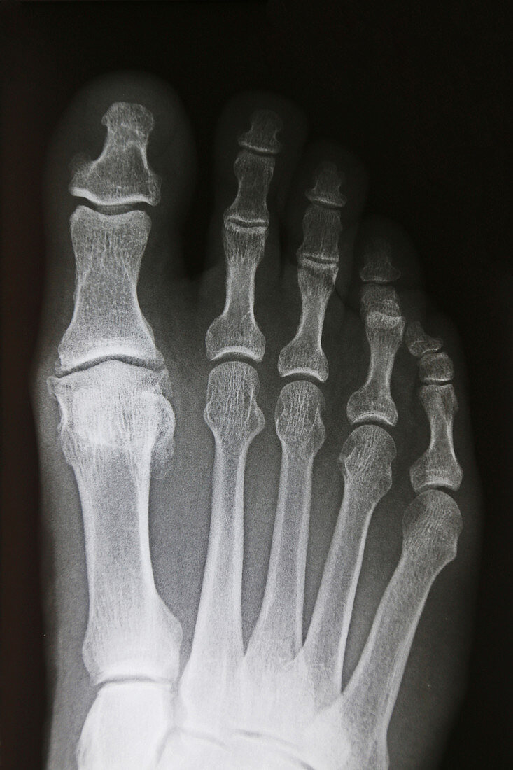 Osteoarthritis of Big Toe,X-ray