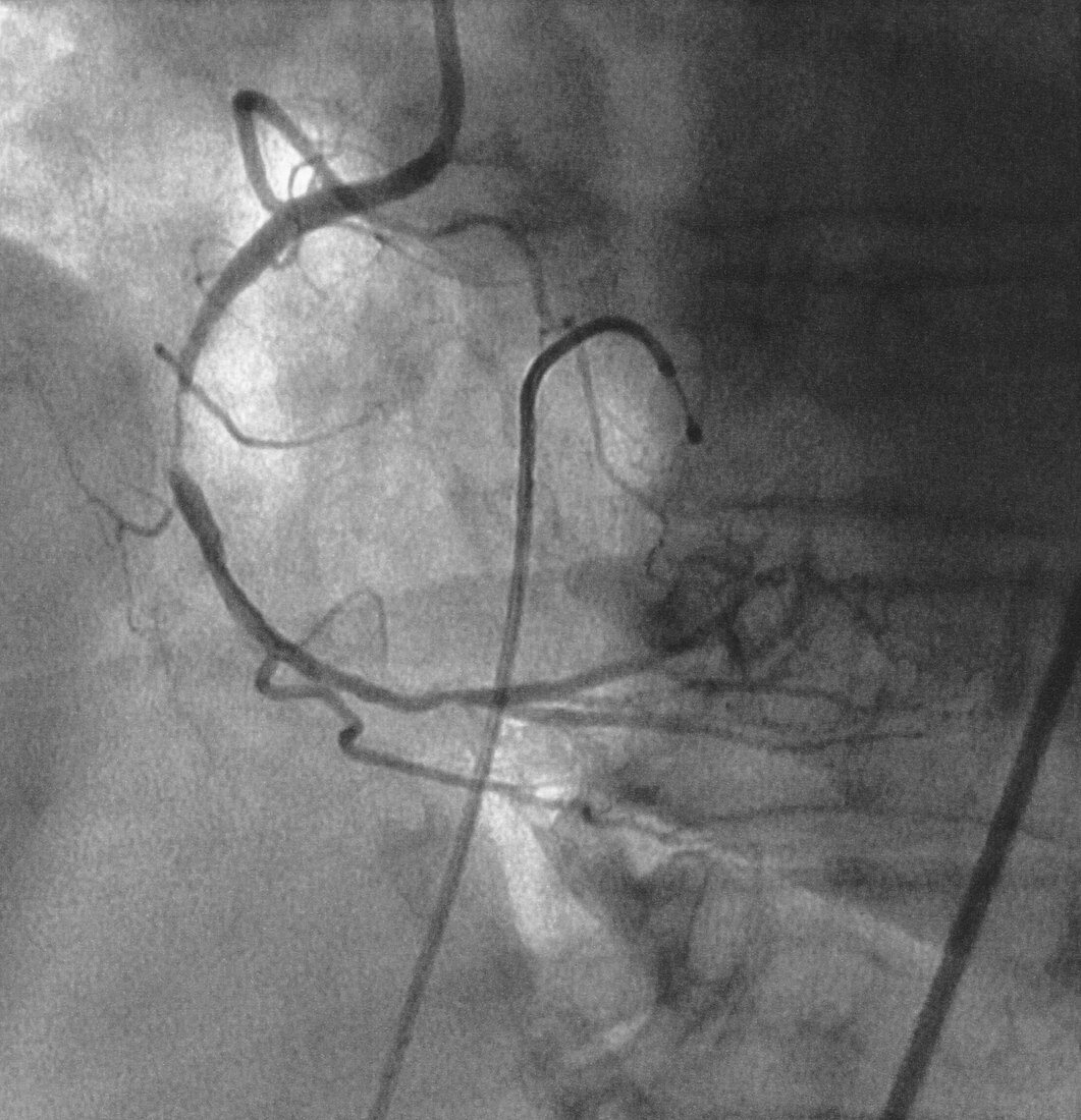 Heart Angiogram Before Stent 1 of 2