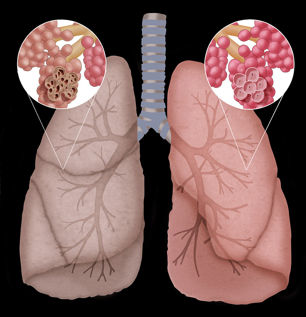 Illustration of Emphysema,Illustration