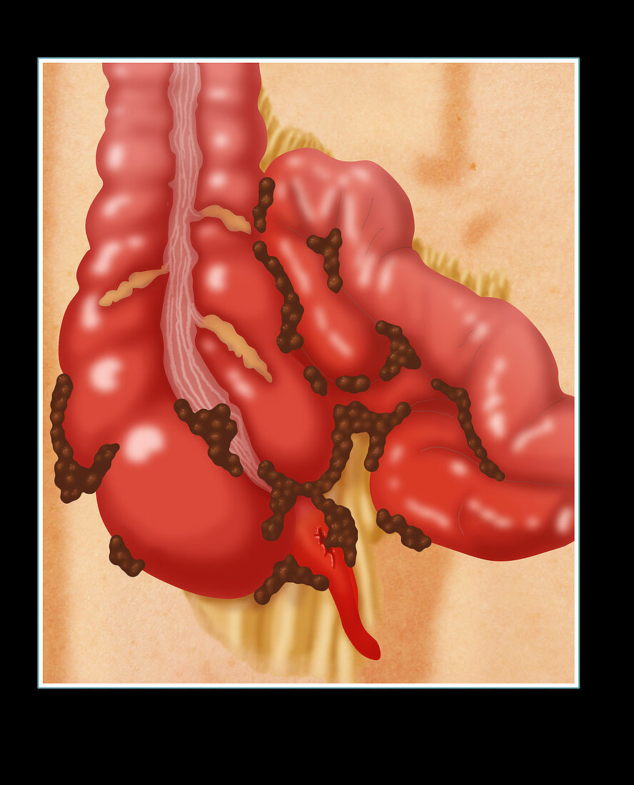 Ruptured Appendix,Illustration