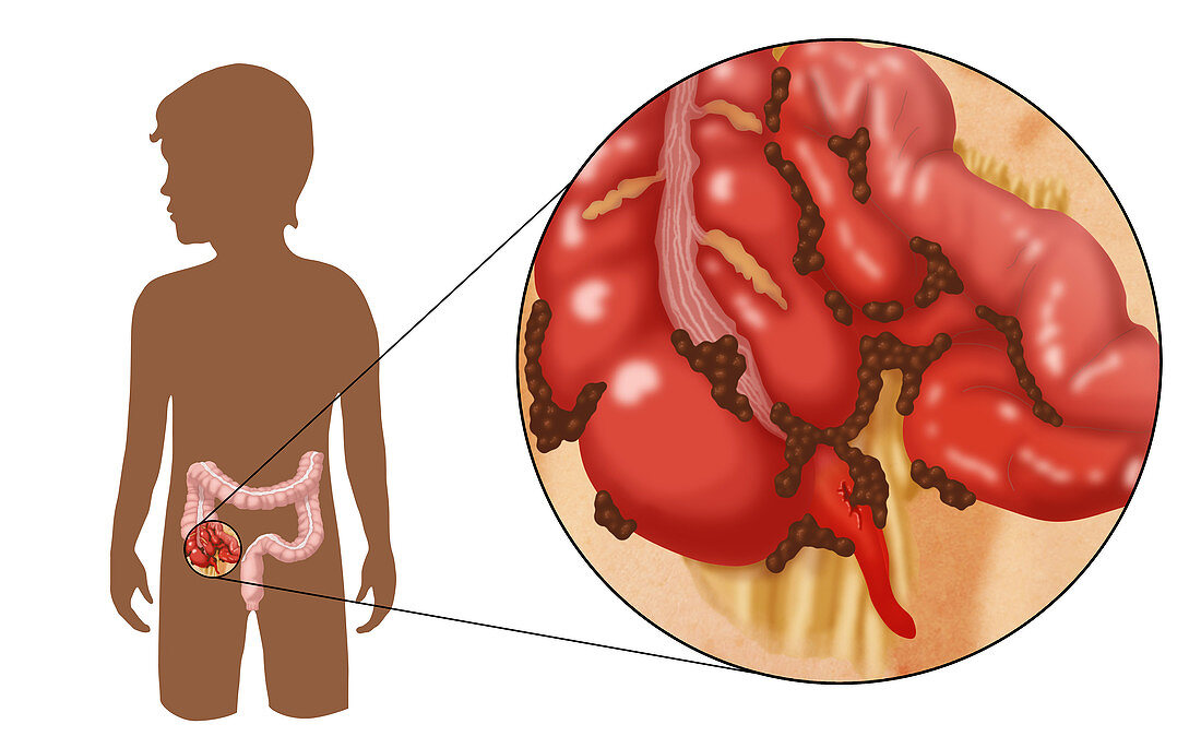 Ruptured Appendix,Illustration