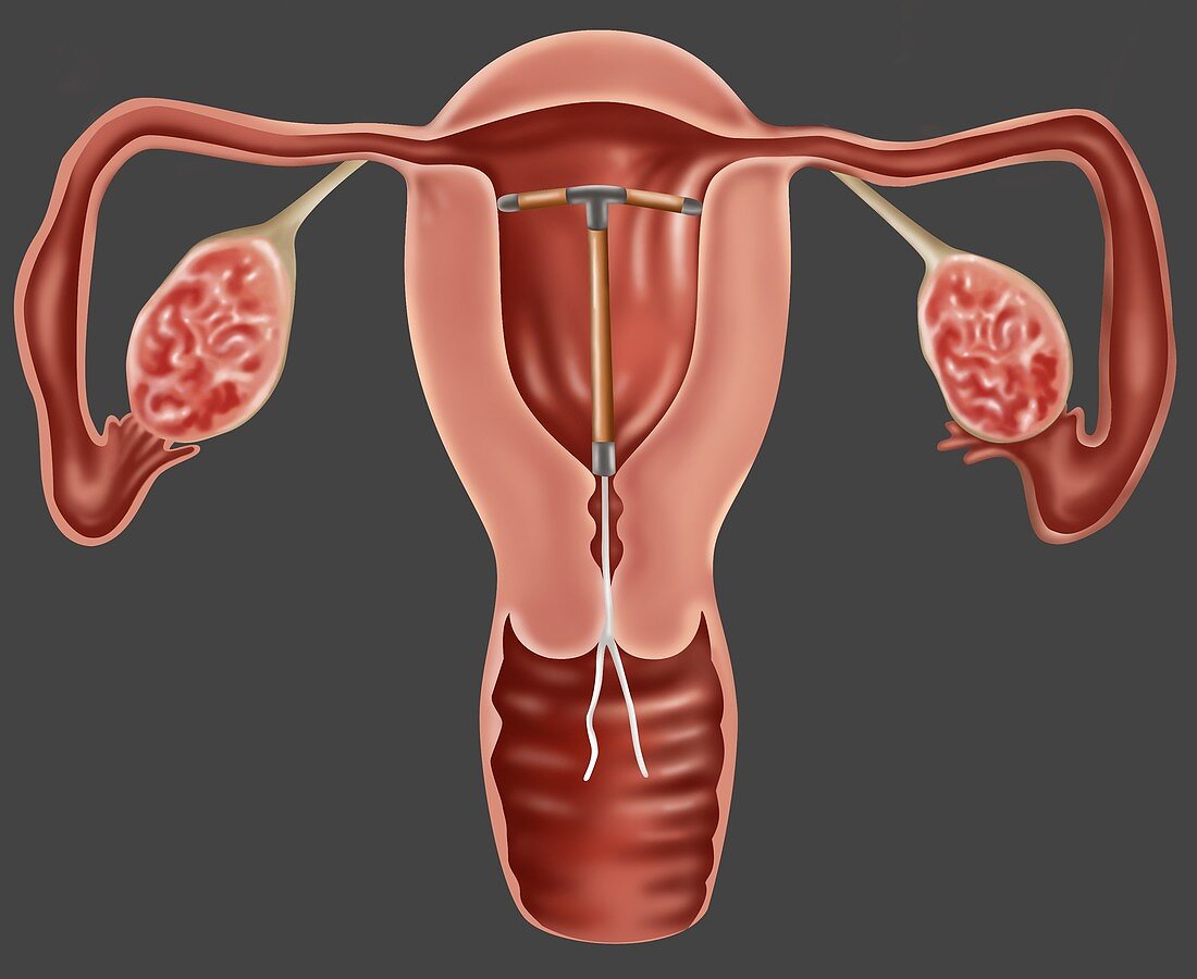 IUD Contraceptive,Illustration