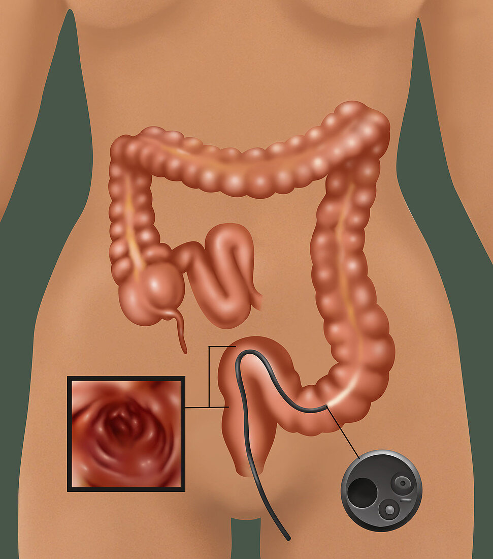 Colonoscopy,Illustration