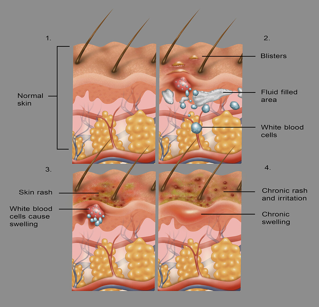 Eczema,Illustration