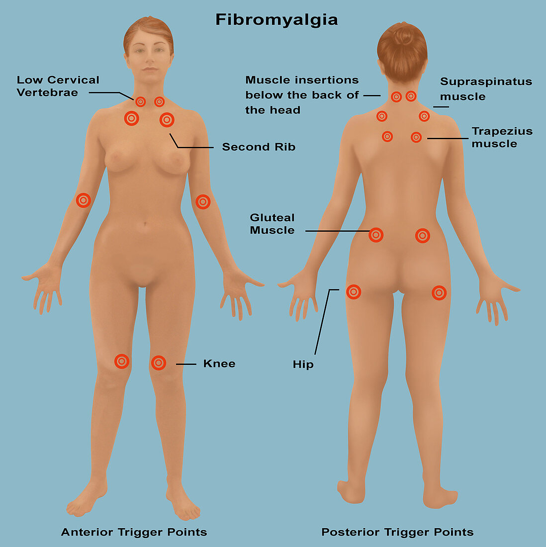 Fibromyalgia,Illustration