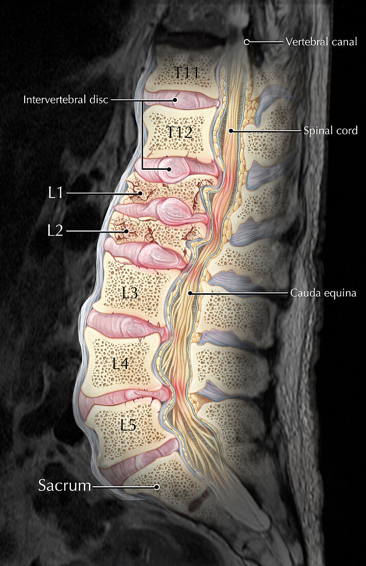 Lumbar Compression Fracture,Illustration